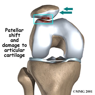 http://www.eorthopod.com/sites/default/files/images/knee_patella_cause01.jpg